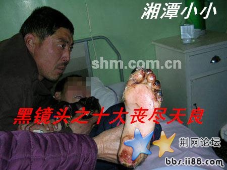 男童遭继父生母虐待被钢针扎手指
