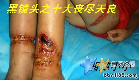 13岁男孩遭父亲“电刑”虐待下身惨不忍暏